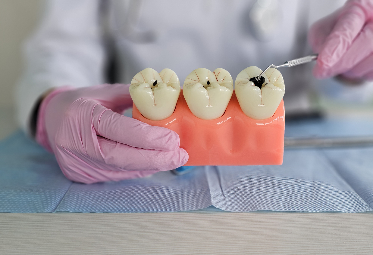 How to Stop Tooth Decay Before it Starts